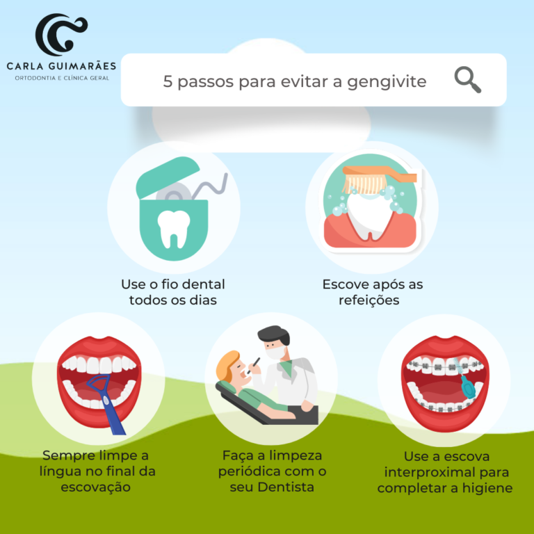 5 Passos para evitar a Gengivite
